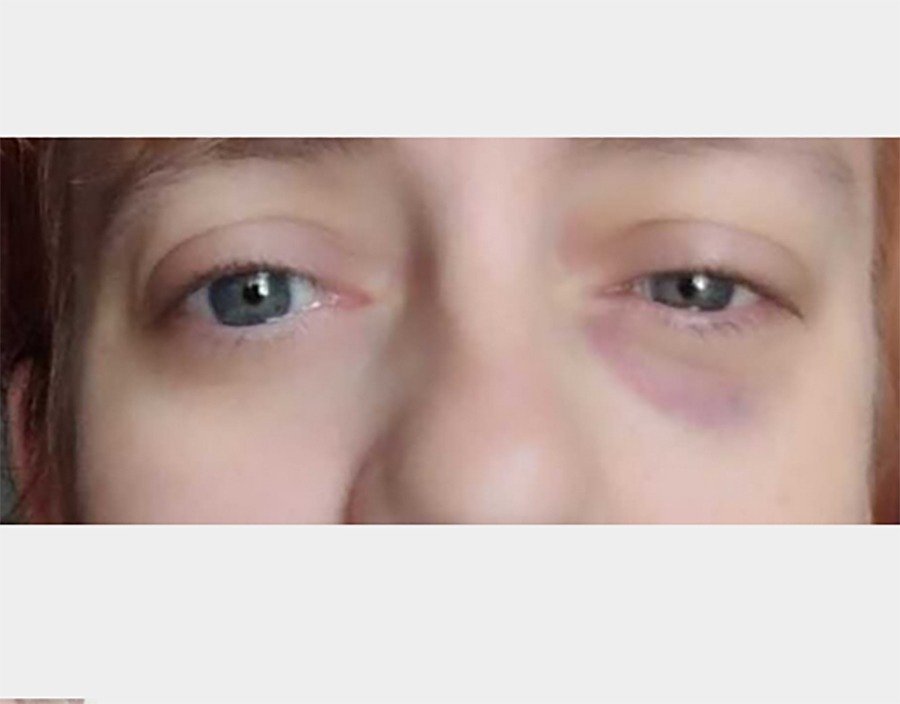 Мать пятерых детей из Ростовской области заболела и потеряла глаз после лечения в больнице