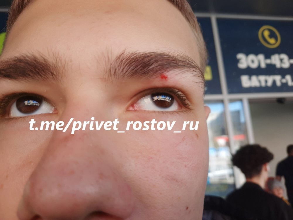 У избитого толпой мужчин ребёнка-инвалида в ТЦ «Орбита» в Ростове, ухудшилось зрение