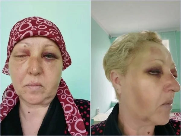 В Ростовской области женщина лишила зрения подругу из- за старой обиды