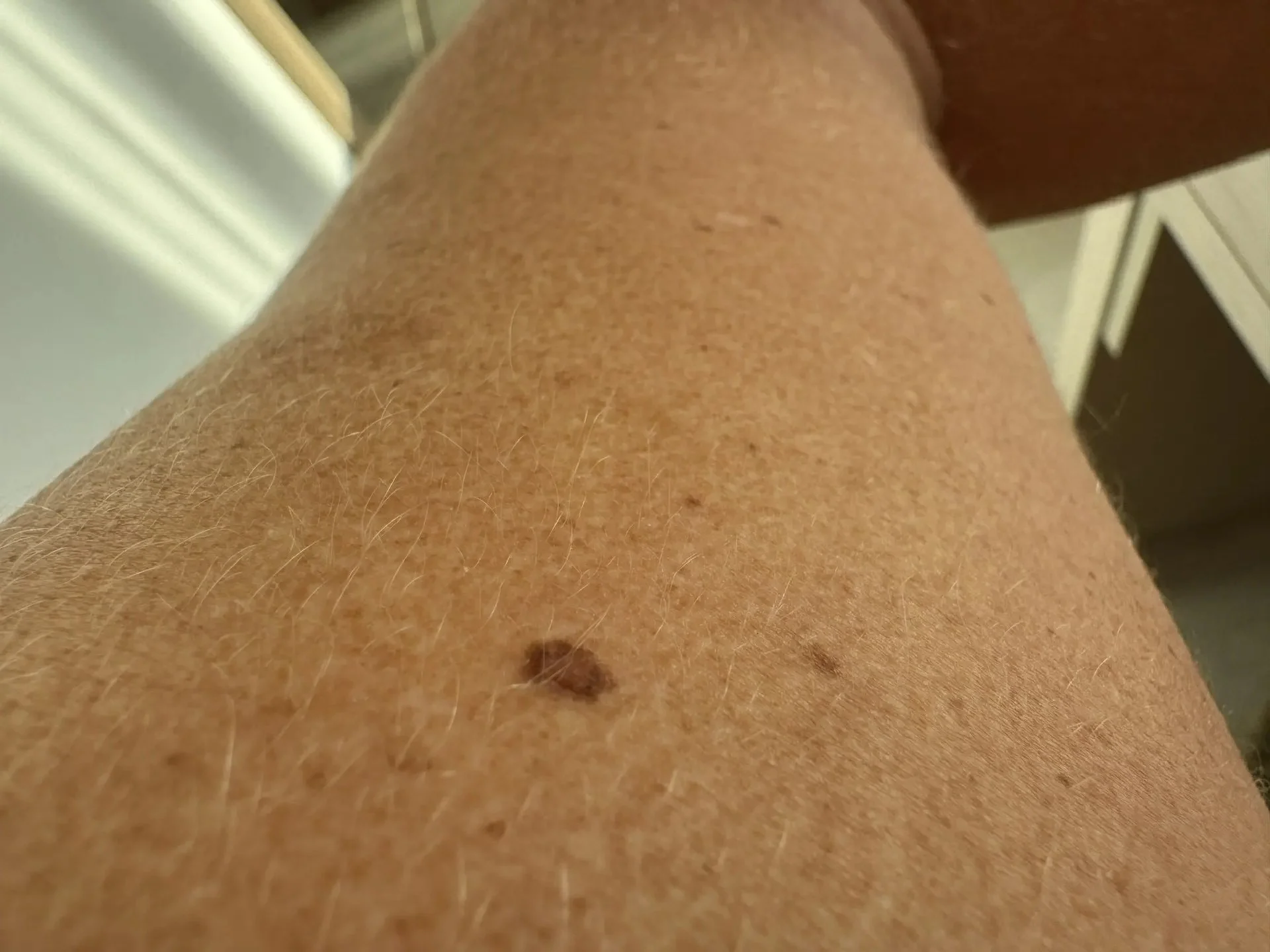 Врач Орлова объяснила, как правило ABCDE помогает выявить рак на ранней стадии