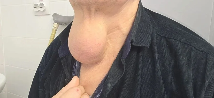 Хирургив Ростове удалили мешок с шеи пациента, который мешал ему 10 лет