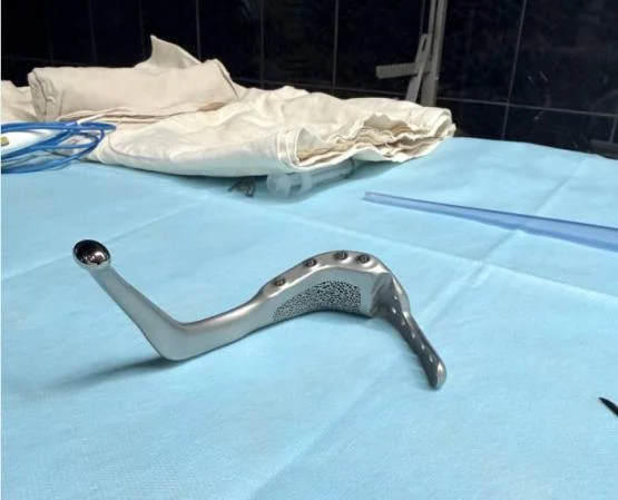 Донские хирурги вживили женщине напечатанную на принтере титановую челюсть