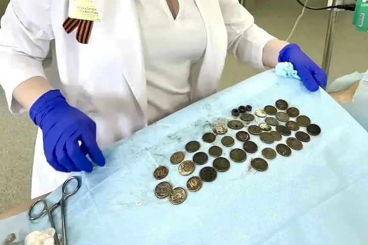В Волгограде врачи достали из пациента более 200 монет и дверные петли